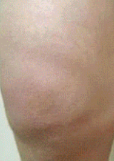 Крем для догляду за нервами ніг при діабеті