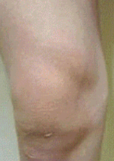 Крем для догляду за нервами ніг при діабеті